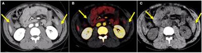 Dual-Energy CT in the Acute Setting: Bowel Trauma